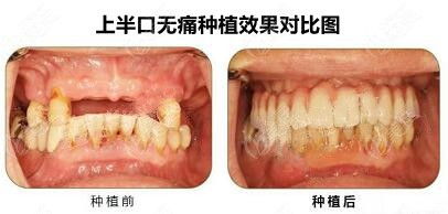 宣城大医口腔做种植牙怎么样 要不看下朱传定医生的即刻种植牙病例图
